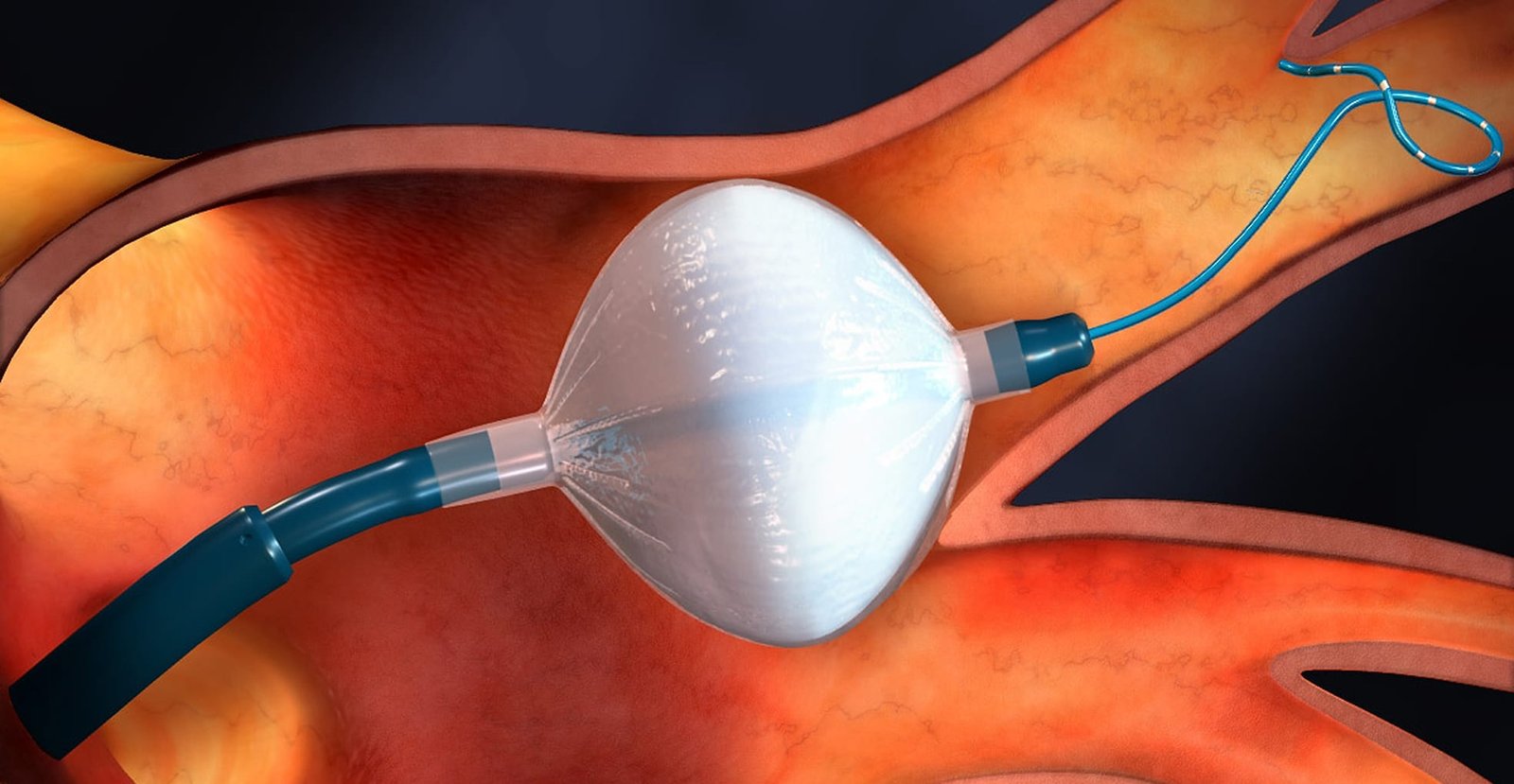 Atrial Fibrillation Devices Market