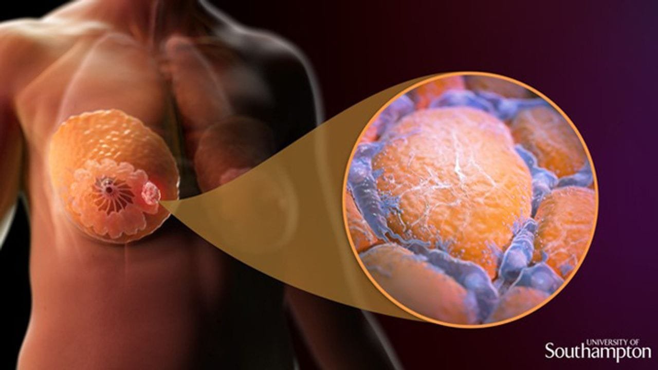 Breast Cancer Therapy Market