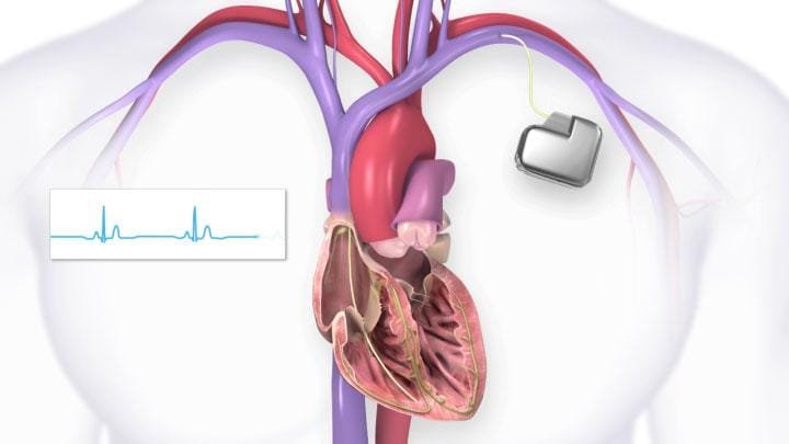 Implantable Heart Pacemaker Market