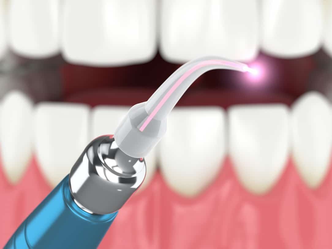 Dental Lasers