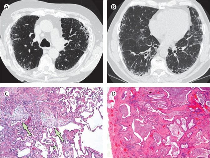 Idiopathic Pulmonary Fibrosis