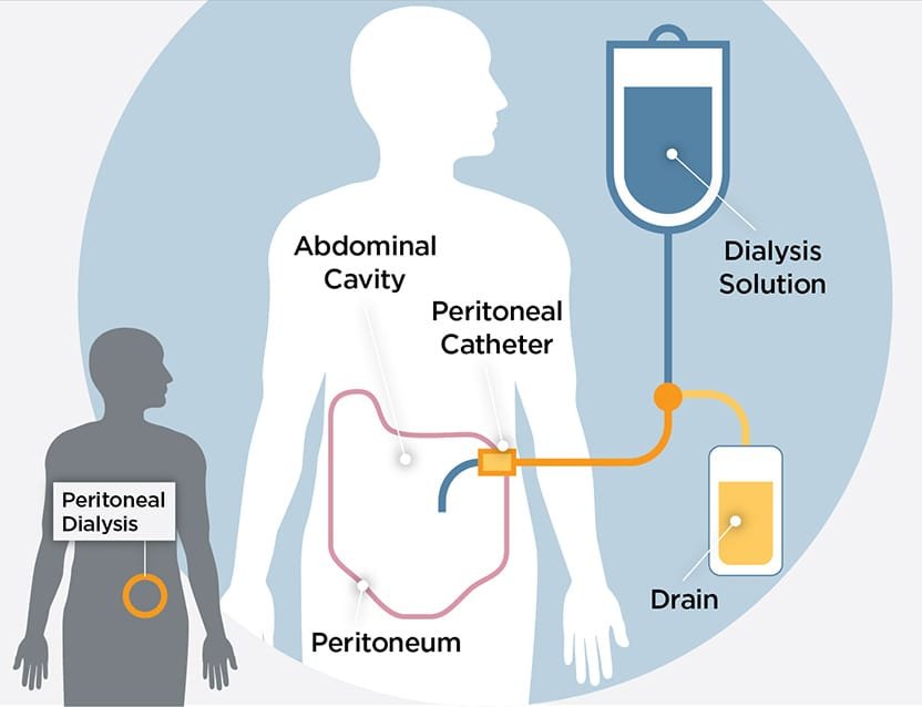 Dialysis Market