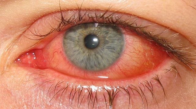 Epidemic Keratoconjunctivitis Treatment Market