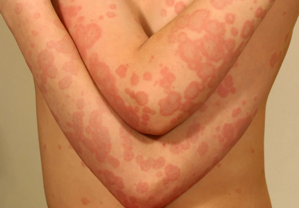 Erythema Treatment Market