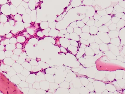 Acquired Aplastic Anemia