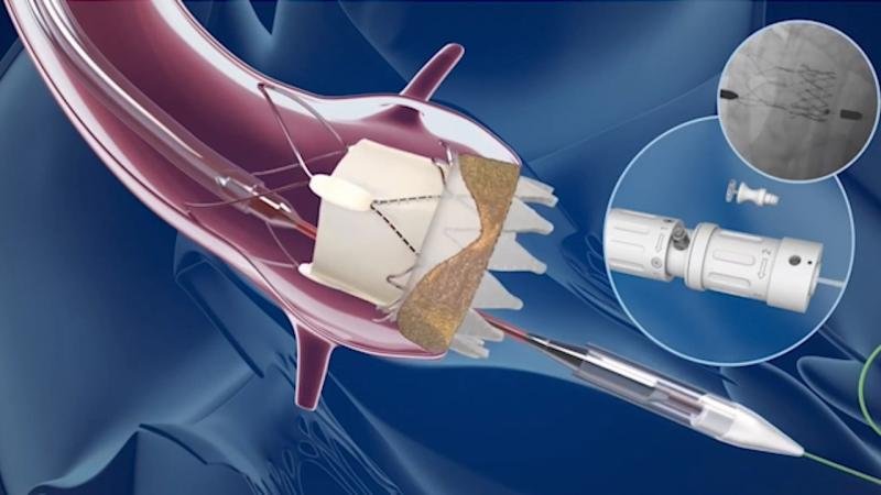 Interventional Cardiology Devices Market