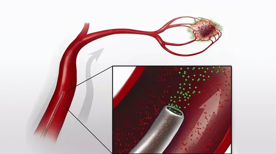 Interventional Oncology Market