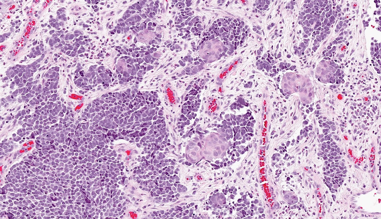 Merkel Cell Carcinoma (MCC) Treatment