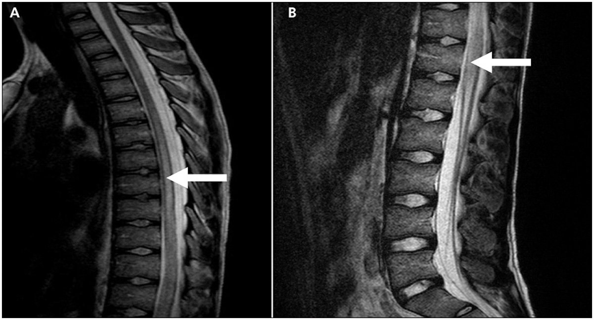 Transverse Myelitis Treatment Market