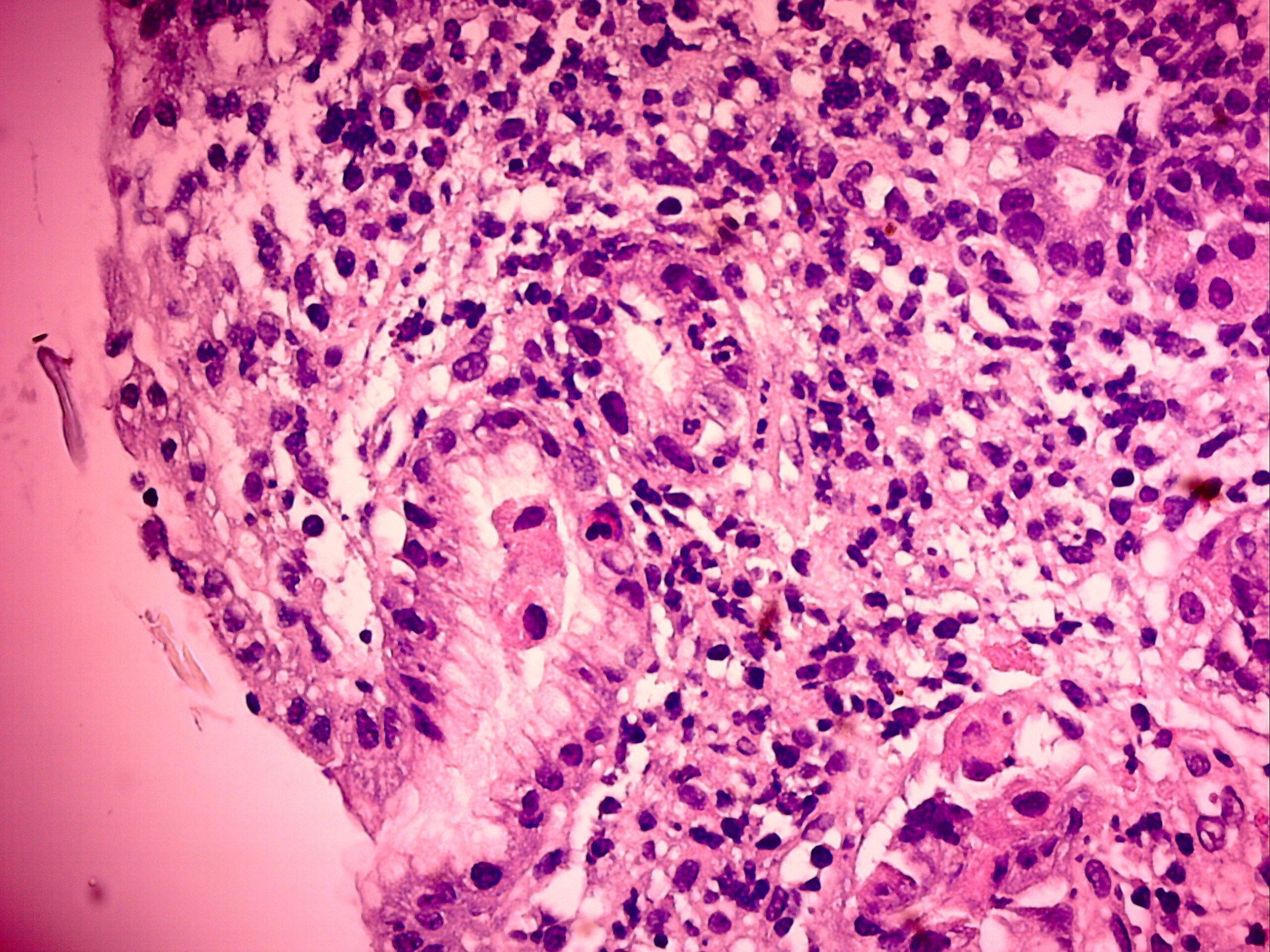 Pathological anatomy. Pathology of the venooclusion disease. Basic Potology Robinson.