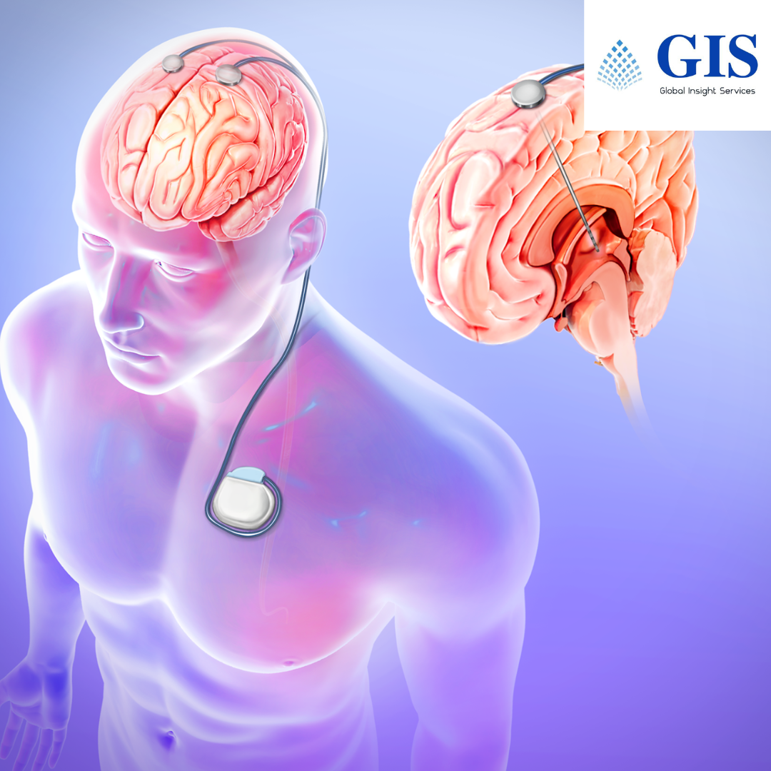 Deep Brain Stimulation Devices Market