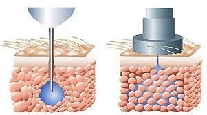 Needle-Free Injection System Market