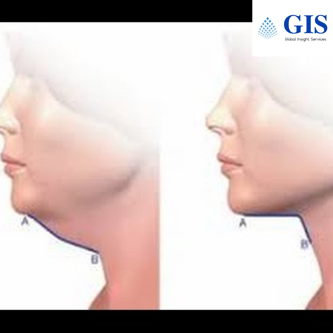 Platysmaplasty Treatment Market