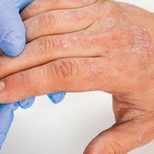 Atopic Dermatitis Clinical Trials Market
